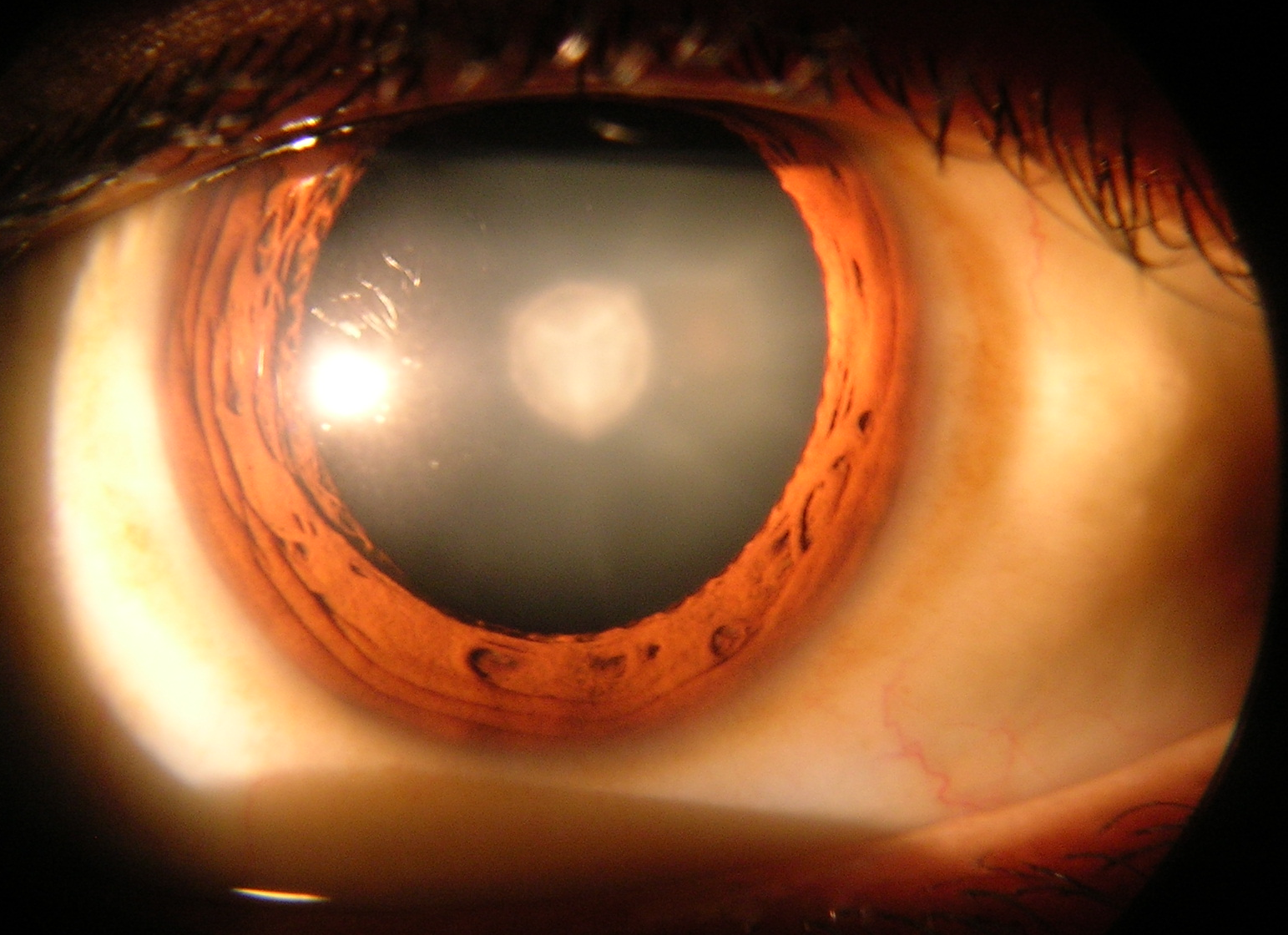 Mature cataract visible in the pupil