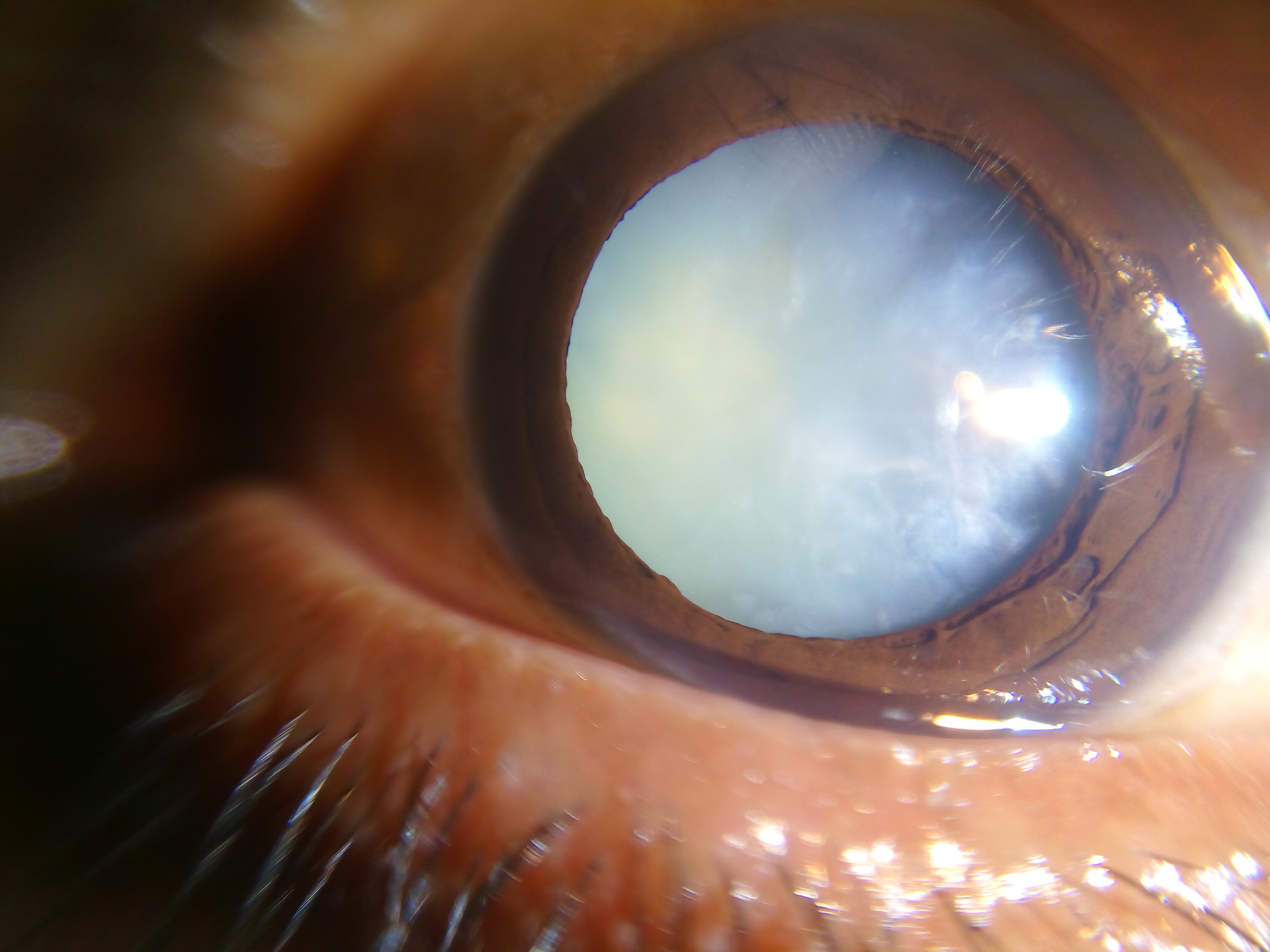 Dense white mature cataract