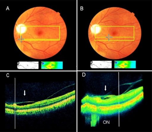 Extrafoveal multifocal vitreoretinal traction associated with pseudophakic <b>CME</b> as detected by the SD-OCT (Pt. 2).