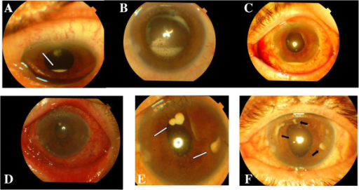 Dense exudate (white arrow) in the inferior capsular bag. (A), endothelial precipitates and increased exudate in the cap