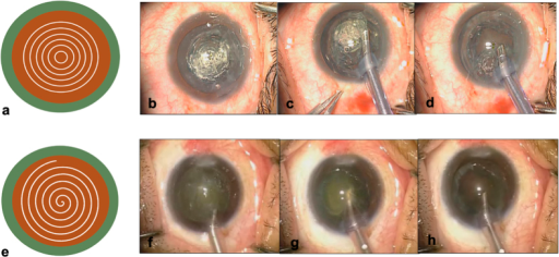 Intraoperative photographs showing cataract surgery with lens-softening pattern and nucleus removal