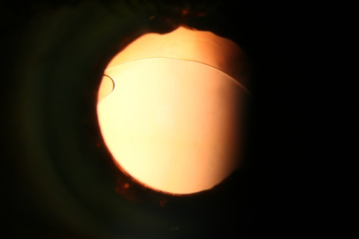 Demonstrates the <b>intraocular lens</b> (IOL) <b>dislocation</b> of one patient with bilateral severe zonular insuffici