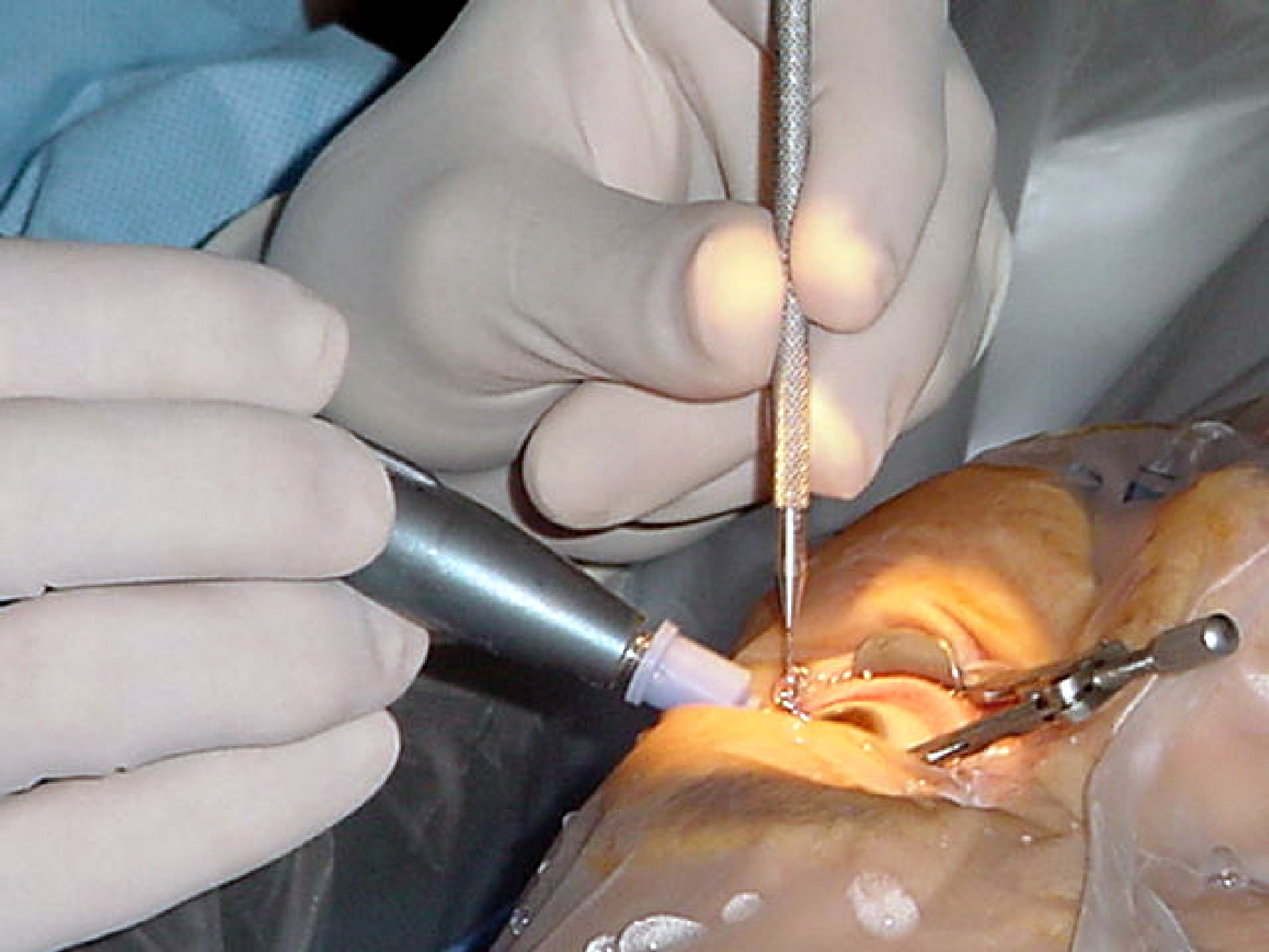 Phacoemulsification cataract surgery