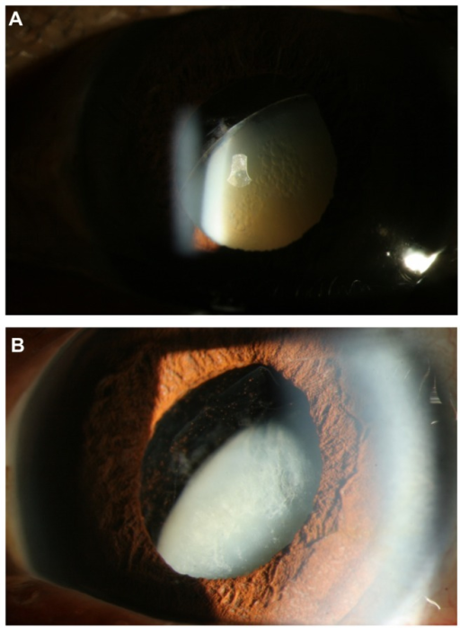 Slit lamp photograph showing subluxed cataractous lens with vitreous prolapse into the anterior chamber