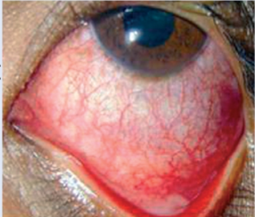 세균결막염의 임상 소견. 결막 충혈과 화농성 분비물이 관찰됨.