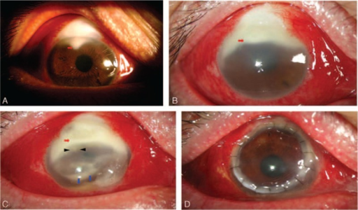 Clinical slit lamp examination of Actinomyces <b>keratitis</b> at the initial visit (A), after 12-week antibiotics treat
