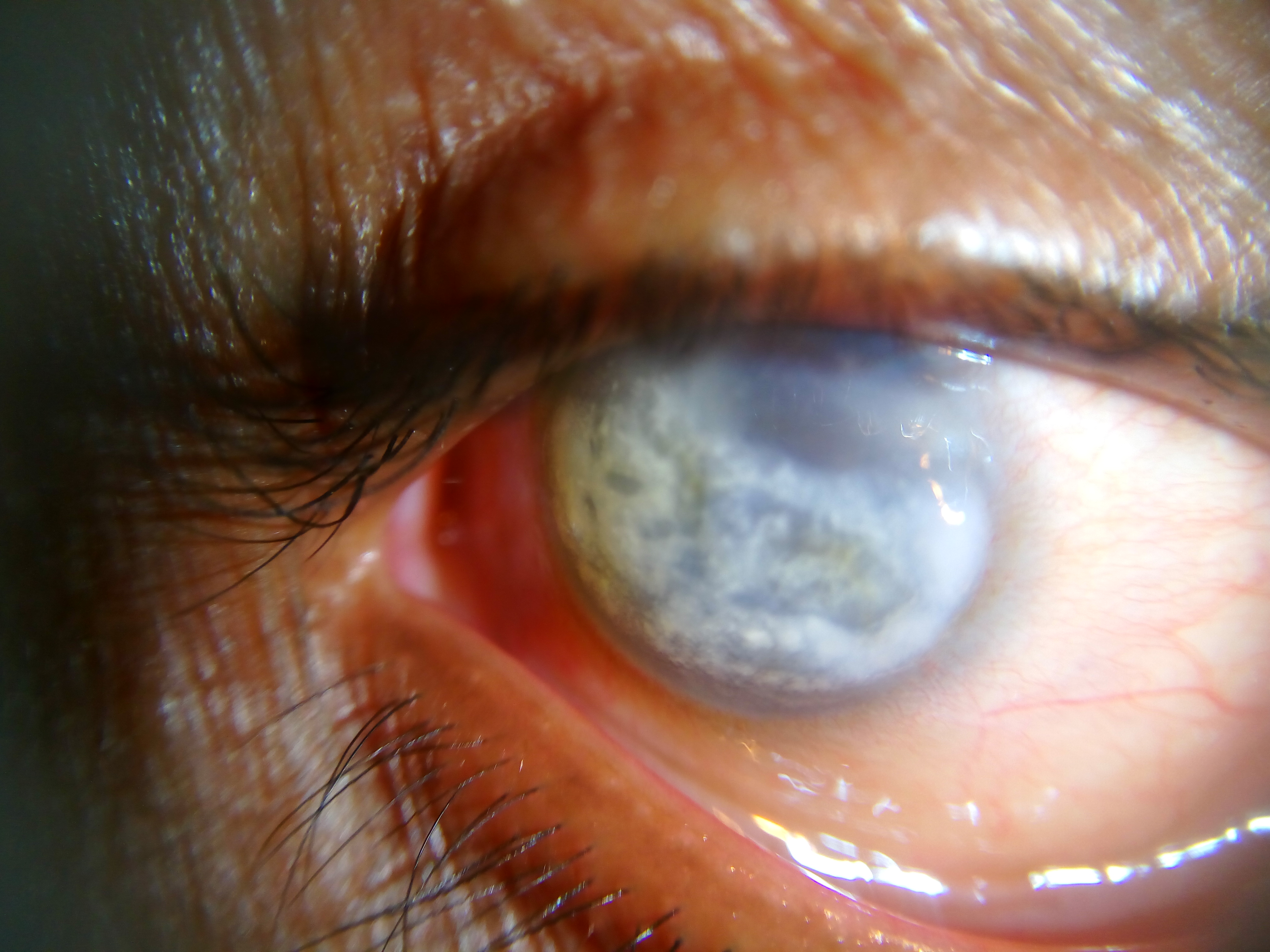 Band keratopathy with calcific deposits