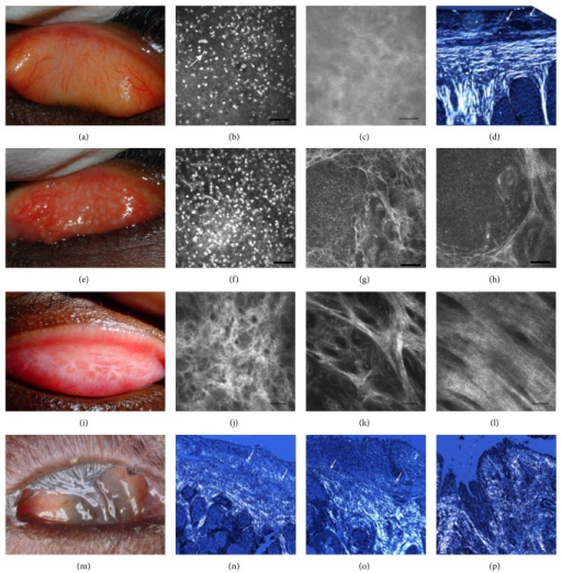 Images from a normal healthy <b>eye</b> (a–d) and from individuals with follicular <b>trachoma</b> (e–h), trachomatous s
