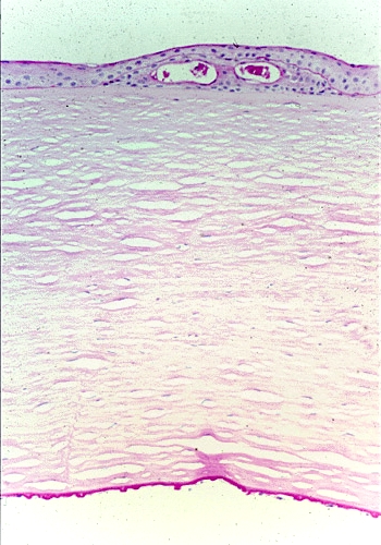 Fuchs endothelial dystrophy corneal guttae