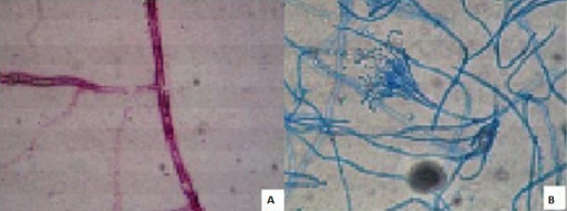 A) microscopic examination of corneal scrapings revealed a septate and branching <b>fungal</b> hyphae; B) branching coni