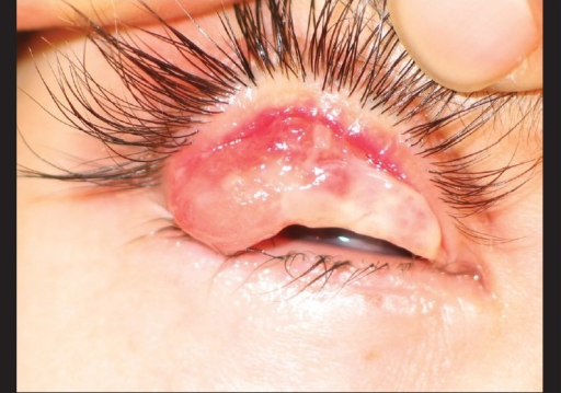 목질결막염의 전안부 소견. 상안검판을 뒤집으면 두껍고 단단한 목질성 위막이 결막을 덮고 있음.