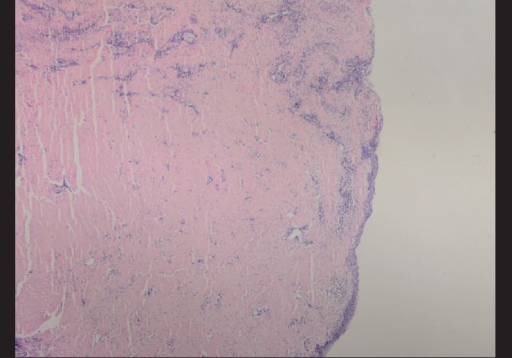 Case 2, histopathological appearance of <b>ligneous conjunctivitis</b>. Large amorphous hyaline-like eosinophilic deposi