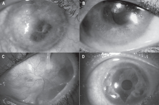 Slit lamp photo showing causes of <b>limbal stem cell deficiency</b> (<b>LSCD</b>). A: Corneal pannus due to vernal kera