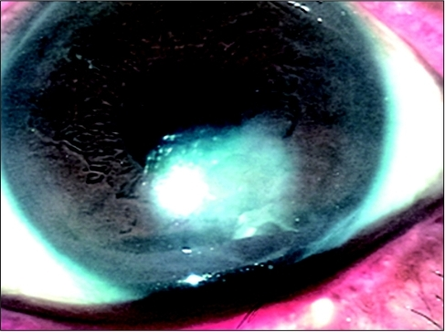 Slit-lamp biomicroscopy on postoperative day 11. Note the punch-out epithelial defect (1.5 × 1.5 mm) with a border of ha