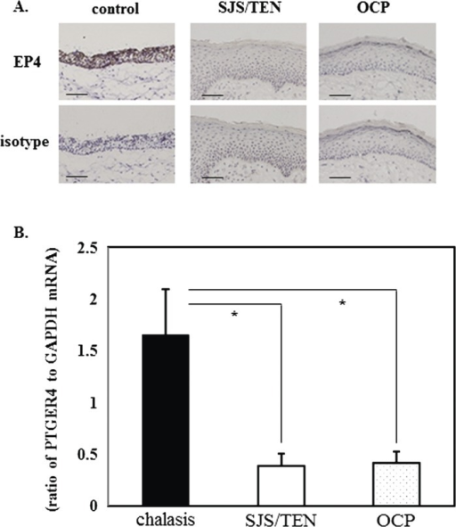 The expression of PTGER4 mRNA in conjunctival tissues from patients with Stevens-Johnson syndrome (SJS)/toxic epidermal 