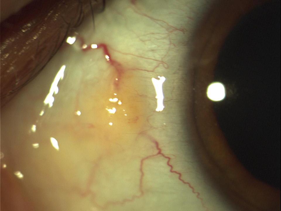 Pinguecula on the nasal conjunctiva