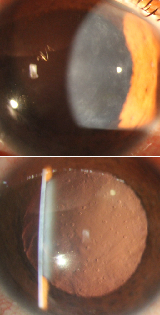 후부다형이영양증(PPMD)의 세극등 소견. 직접조명에서 데스메막 지도형 혼탁, 역조명에서 소포(vesicle) 병변.