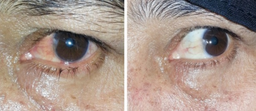 Showing clinical appearance of <b>pterygium</b> before and after treatment.