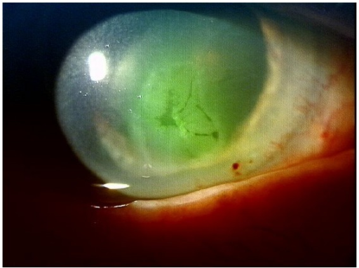 Example of a persistent <b>corneal erosion</b> after HSO endotamponade surgery.