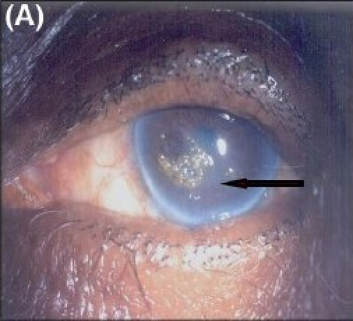 구상변성의 전안부 소견. 중심 각막에 융기된 구상 침착 병변이 관찰됨.
