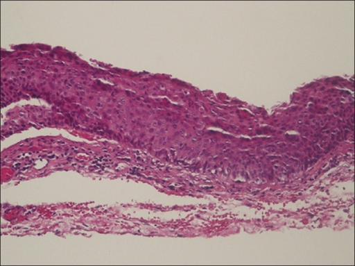 Pathology showing acanthotic, nonkeratinized epithelial layer. Dysplasia is noted 2/3 of the way through the specimen. A