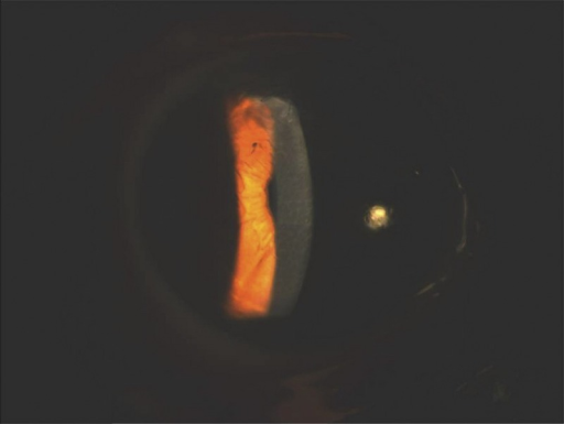 Anterior segment evaluation by slit lamp at the 2-year follow-up showed no obvious change in the lattice lesions in the 
