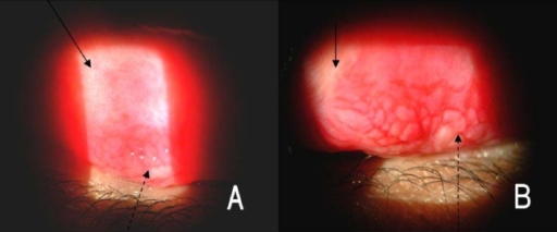 Giant papillae with flat tops on the upper tarsal conjunctiva (dot-arrow), typically described as a 'cobblestone' appear