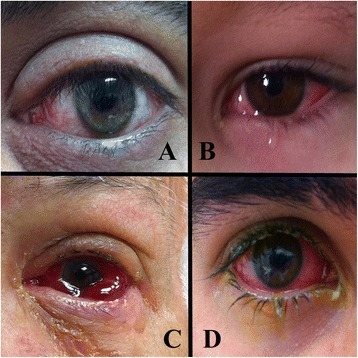 Clinical manifestations of acute <b>conjunctivitis</b>. A. Acute <b>viral conjunctivitis</b>. Conjunctival erythema is v