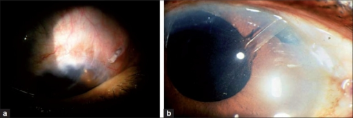 The <b>glaucoma drainage devices</b> come with a new set complications (a) Tube retraction and exposure (b) Vitreous Blo