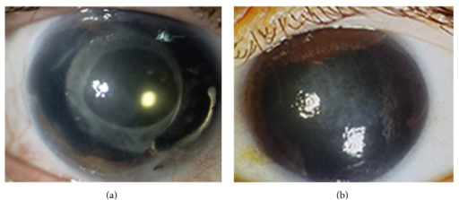 Two patients with <b>essential iris atrophy</b> showing extensive <b>iris atrophy</b> and peripheral anterior synechiae 