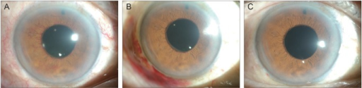 Regression of iris neovascularization after subconjunctival injection of bevacizumab
