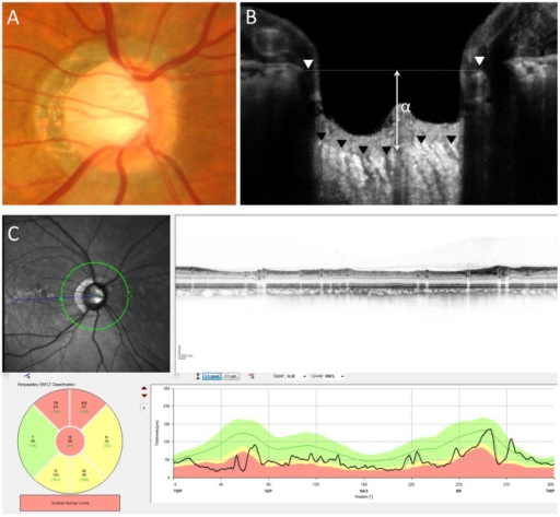 정상안압녹내장의 시신경유두 및 OCT 소견