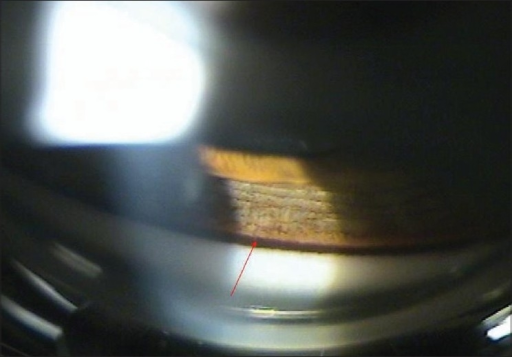 Gonioscopy showing dense pigment deposits in the trabecular meshwork in pigment dispersion syndrome