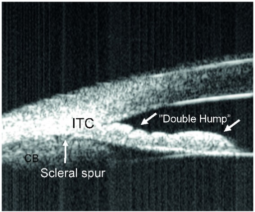 UBM showing plateau iris with characteristic double-hump appearance and iridotrabecular contact (ITC)
