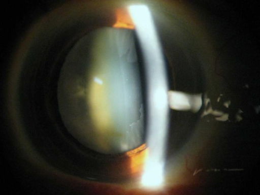 An eye with <b>pseudoexfoliation</b> showing the dandruff like <b>pseudoexfoliation</b> material on the surface of the c