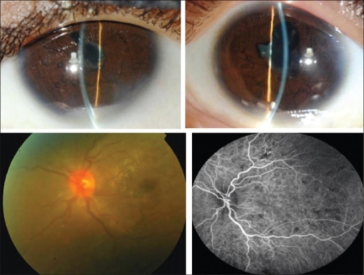 Slit-lamp photographs showing mutton-fat keratic precipitates, posterior synechiae, and anterior chamber exudate in uveitic glaucoma