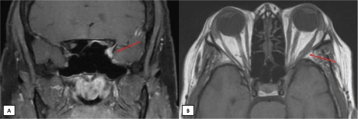 T1 and T2-weighted MRI with gadolinium contrast of the brain and orbits.Notes: Coronal T2-weighted MRI disclosing a 5×9×