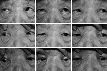 Nine gaze positions showing overelevation in adduction characteristic of superior oblique palsy
