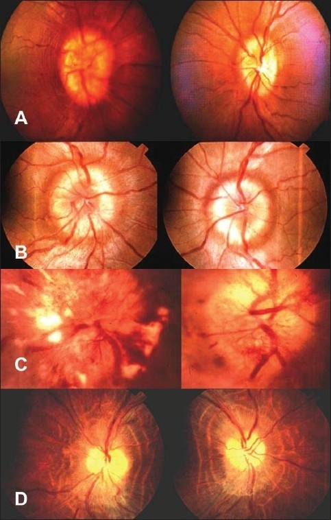 Fundus pictures showing (A) early papilledema (B) established papilledema (C) vintage papilledema and (D) atrophic papil