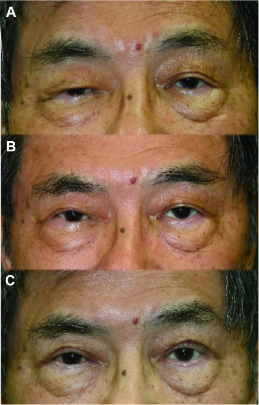 Case 2: A 75-year-old man with right upper blepharoptosis due to myasthenia gravis and brow ptosis