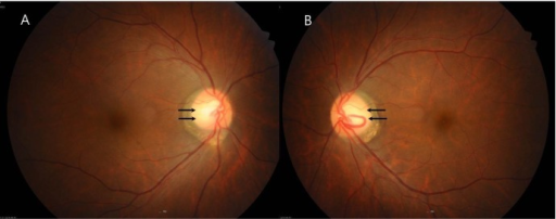 Bilateral fundus photographs showing temporal optic disc pallor (arrows) indicating optic atrophy