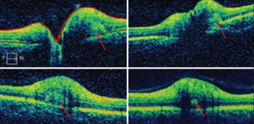 Optical coherence tomography images comparing papilledema and pseudopapilledema with optic nerve head drusen