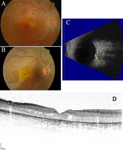 Fundus photographs showing optic disc drusen with elevated optic nerve head, B-scan ultrasonography showing calcification, and OCT cross-section
