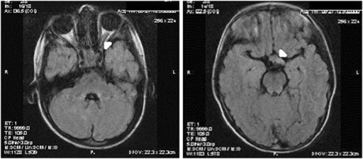 MRI showing <b>optic glioma</b> affecting the <b>optic</b> chiasm; left - thickening of the <b>optic nerve</b> (arrowhea