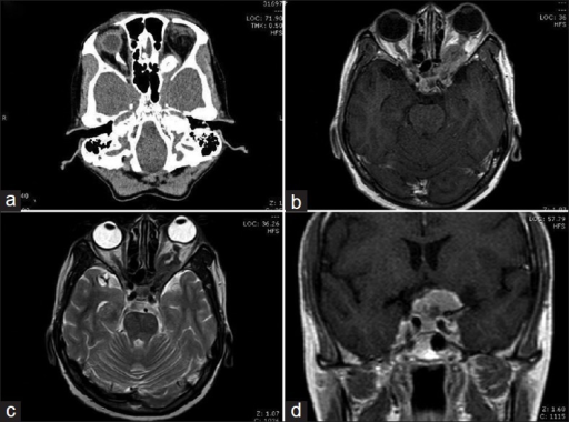 CT and MRI of bilateral optic nerve sheath meningioma showing tram-track sign. (a) Axial CT with calcification, (b-d) MRI demonstrating optic nerve sheath enhancement.
