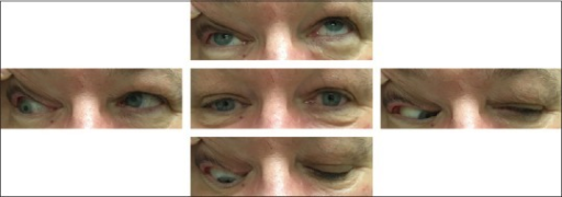 Photographs demonstrating resolution of the <b>third nerve palsy</b> 4 months after epidural spinal injection. The cente