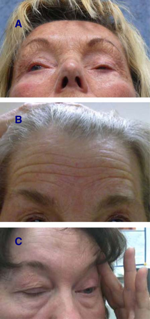 Adult patient with benign essential blepharospasm showing bilateral forced eye closure