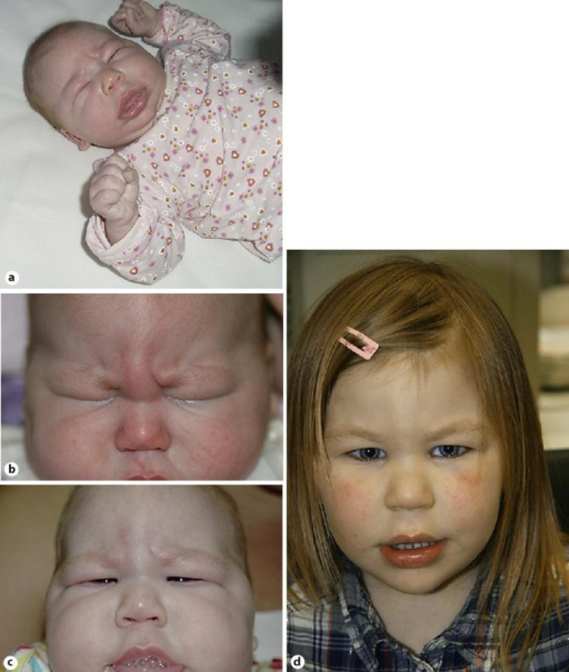 a Status during the day at 3 weeks of age (picture taken by parents). b Typical findings during examination at 7 weeks o