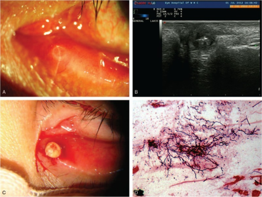 Clinical feature of canalicular <b>concretions</b>. (A) A swollen pouting punctum and eyelid erythema. (B) Ultrasonic im