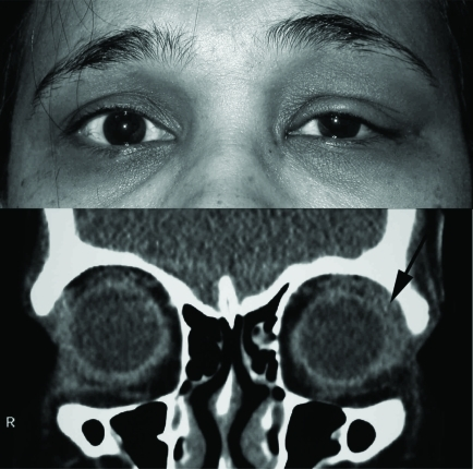 Clinical photograph showing lateral upper eyelid swelling in dacryoadenitis with corresponding coronal CT demonstrating lacrimal gland enlargement